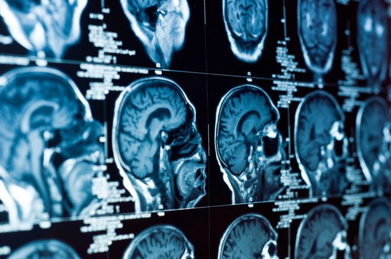 exploring how brain injuries occur and their consequences